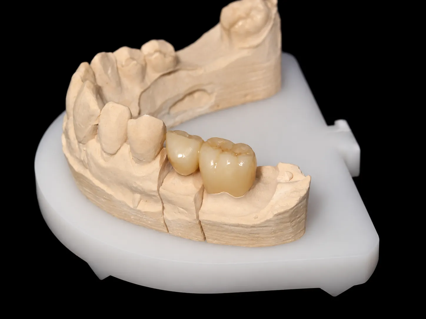 Corona dental sobre un modelo de trabajo en la clínica